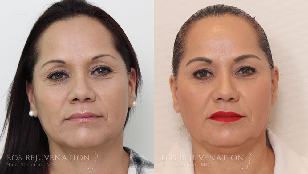 Liquid Facelift Before & After