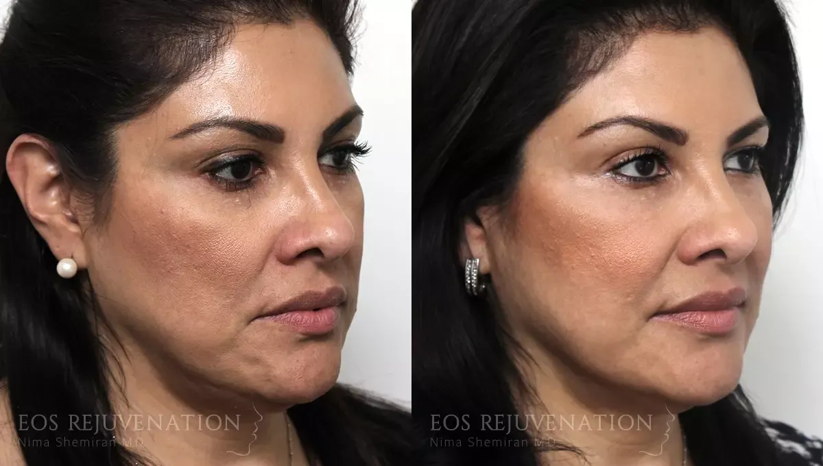 Liquid Facelift Before & After