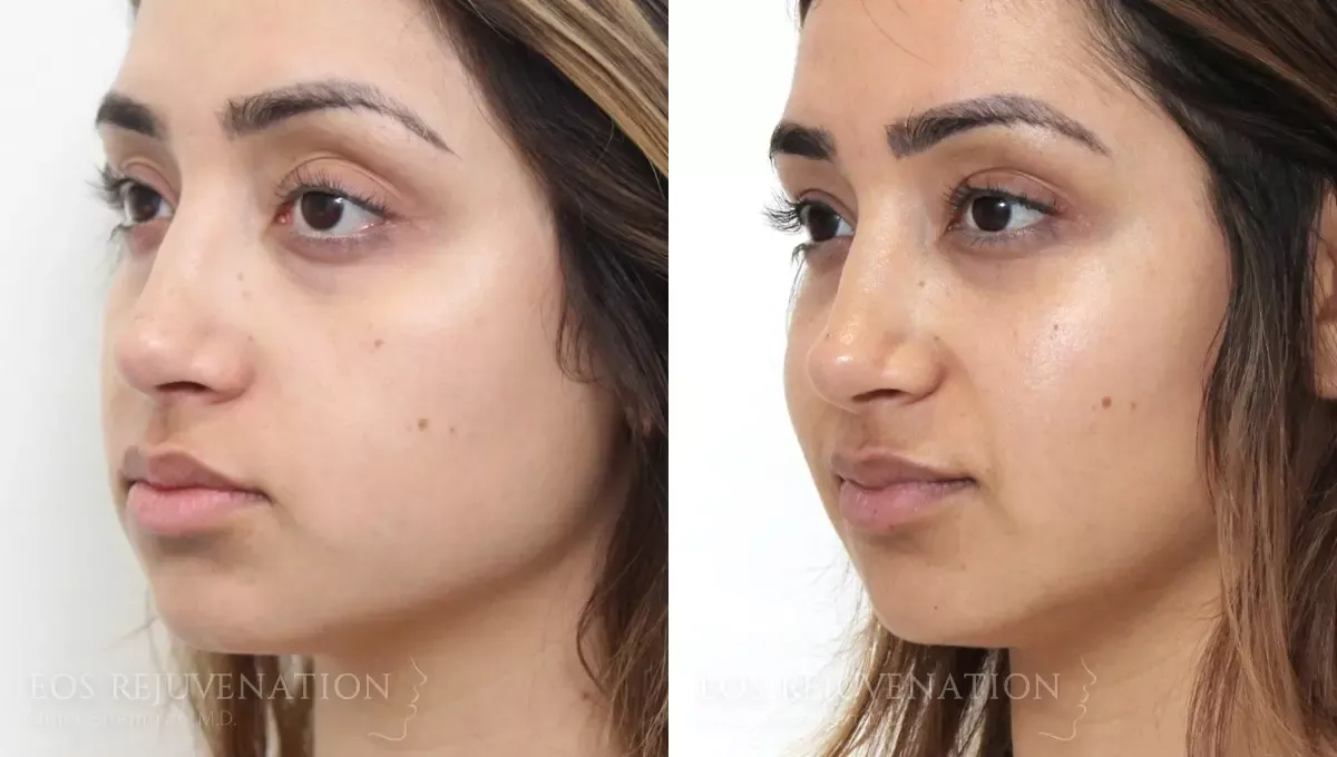Cheek Augmentation Before & After