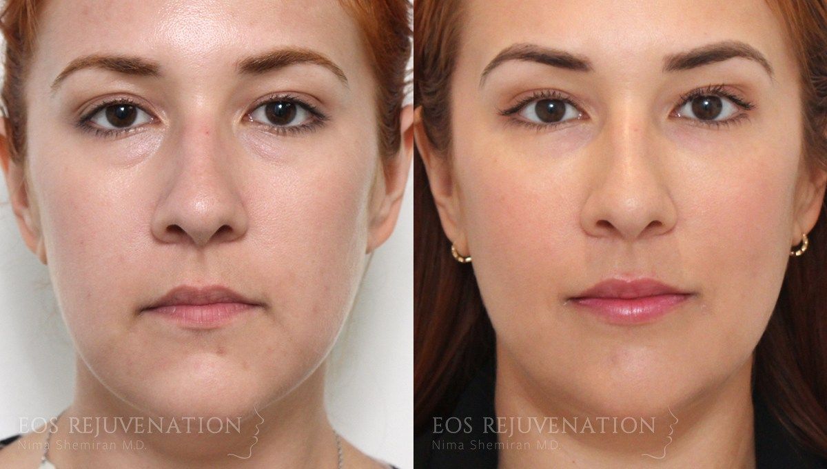 Cheek Augmentation Before & After
