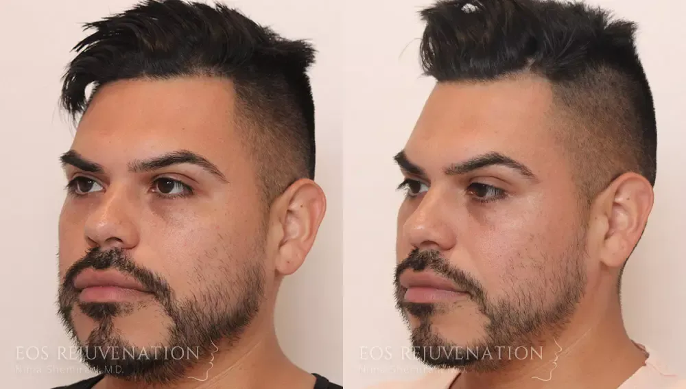 Cheek Augmentation Before & After