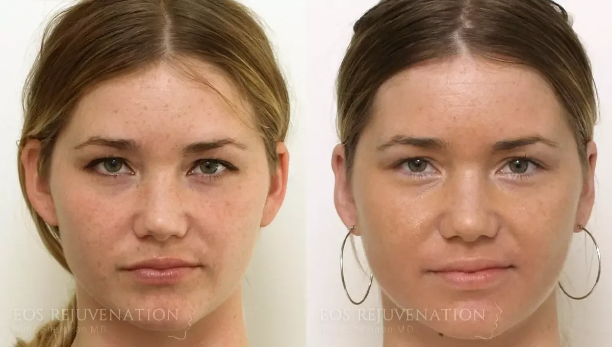 Otoplasty Before & After