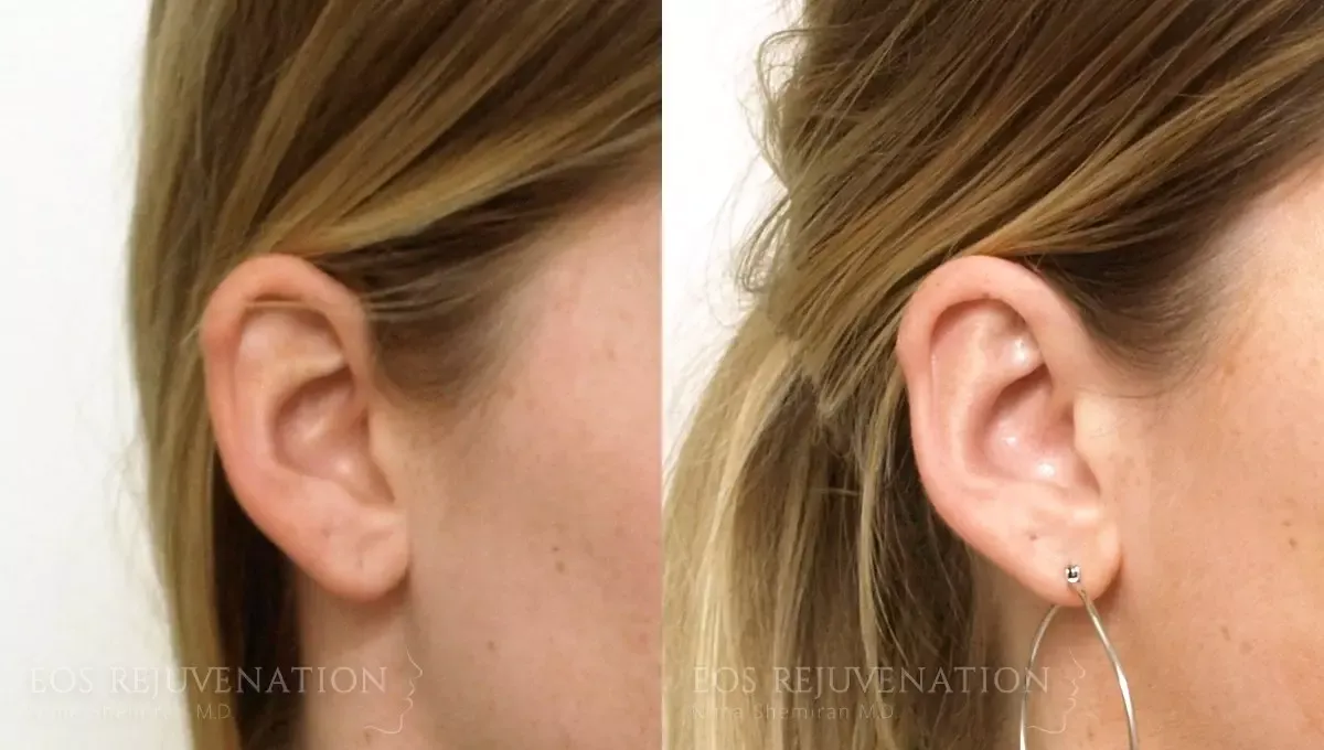 Otoplasty Before & After