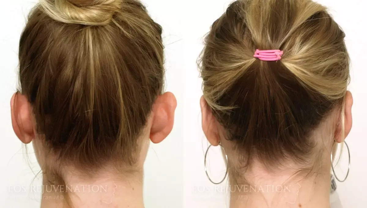 Otoplasty Before & After
