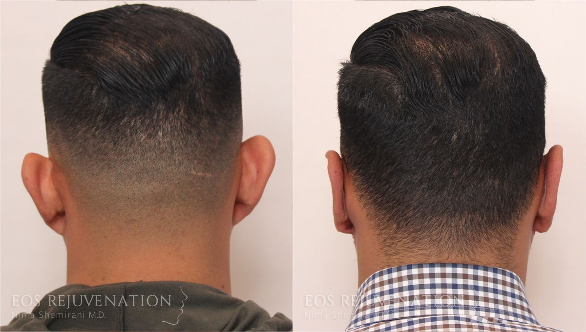 Otoplasty Before & After