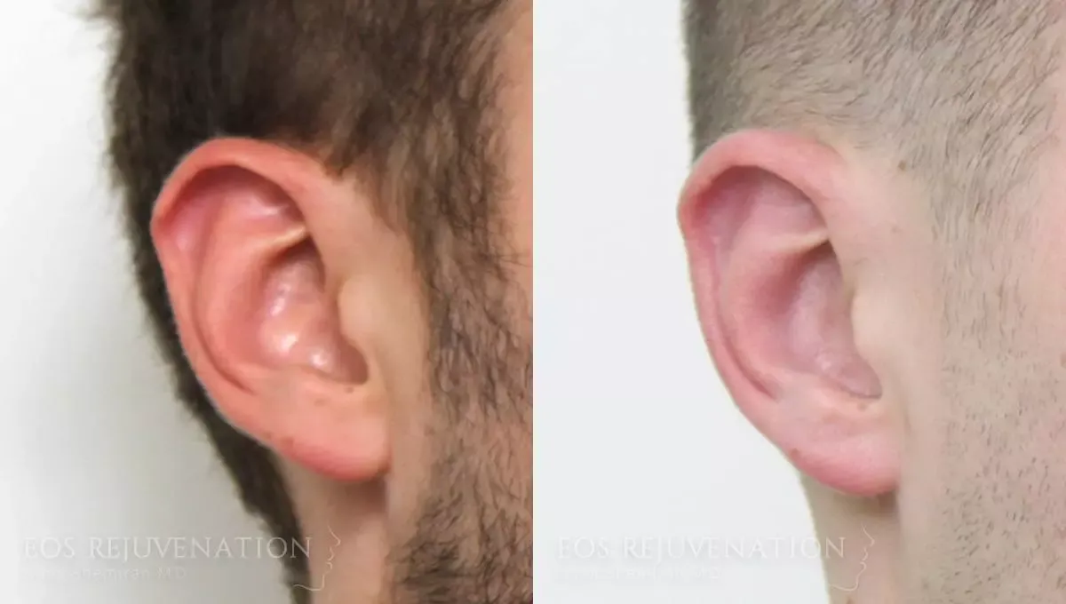 Otoplasty Before & After