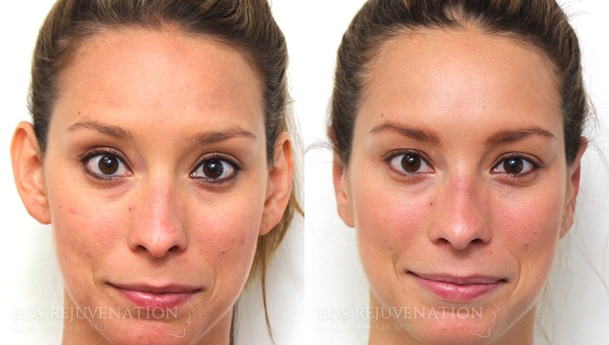 Otoplasty Before & After