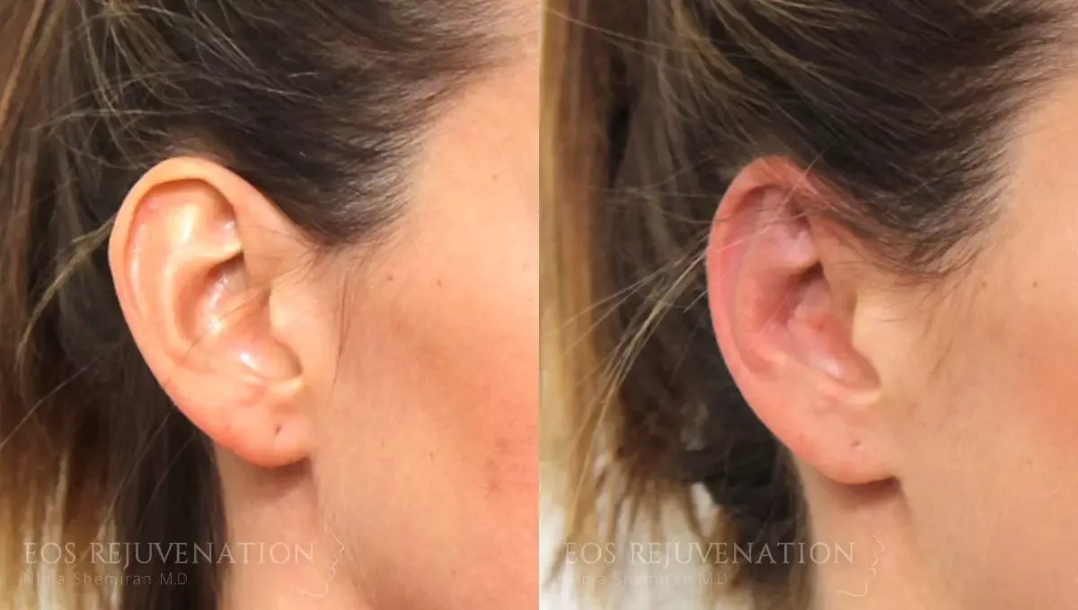 Otoplasty Before & After