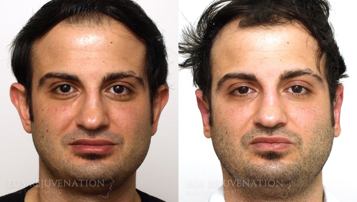 Otoplasty Before & After