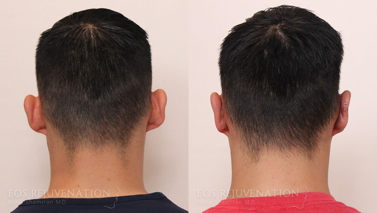 Otoplasty Before & After