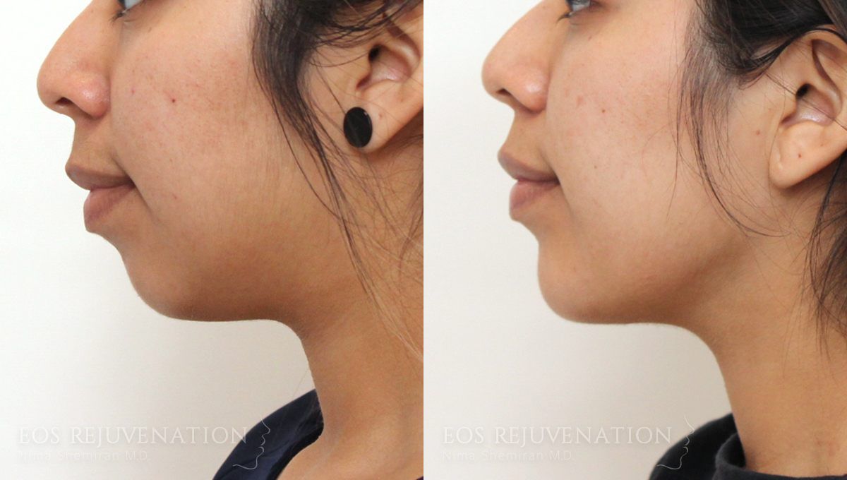 Neck Jawline Liposuction Before & After