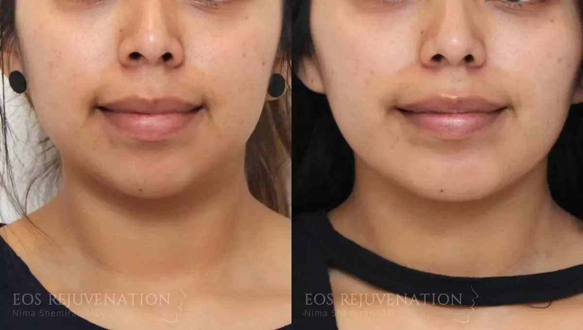 Neck Jawline Liposuction Before & After
