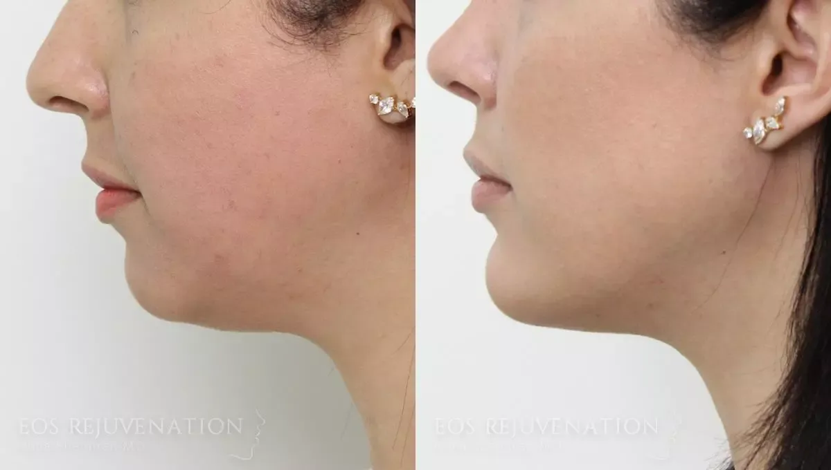Neck Jawline Liposuction Before & After