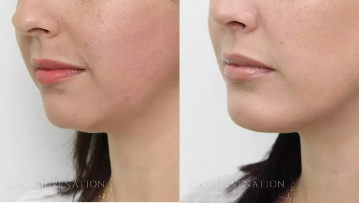 Neck Jawline Liposuction Before & After