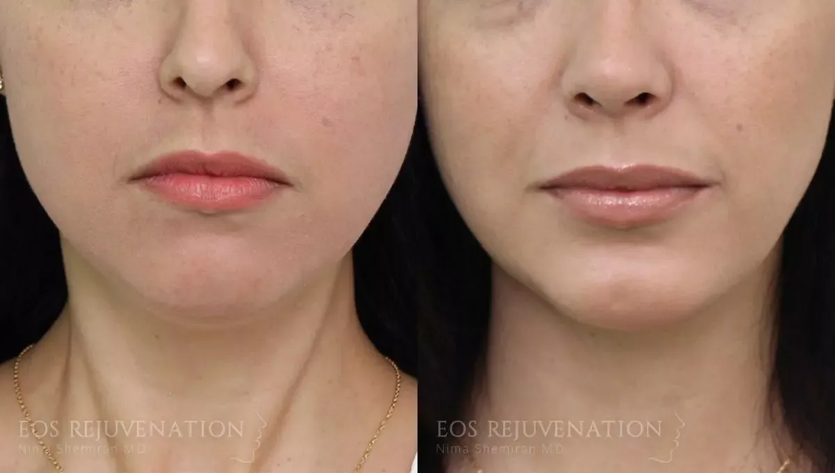 Neck Jawline Liposuction Before & After
