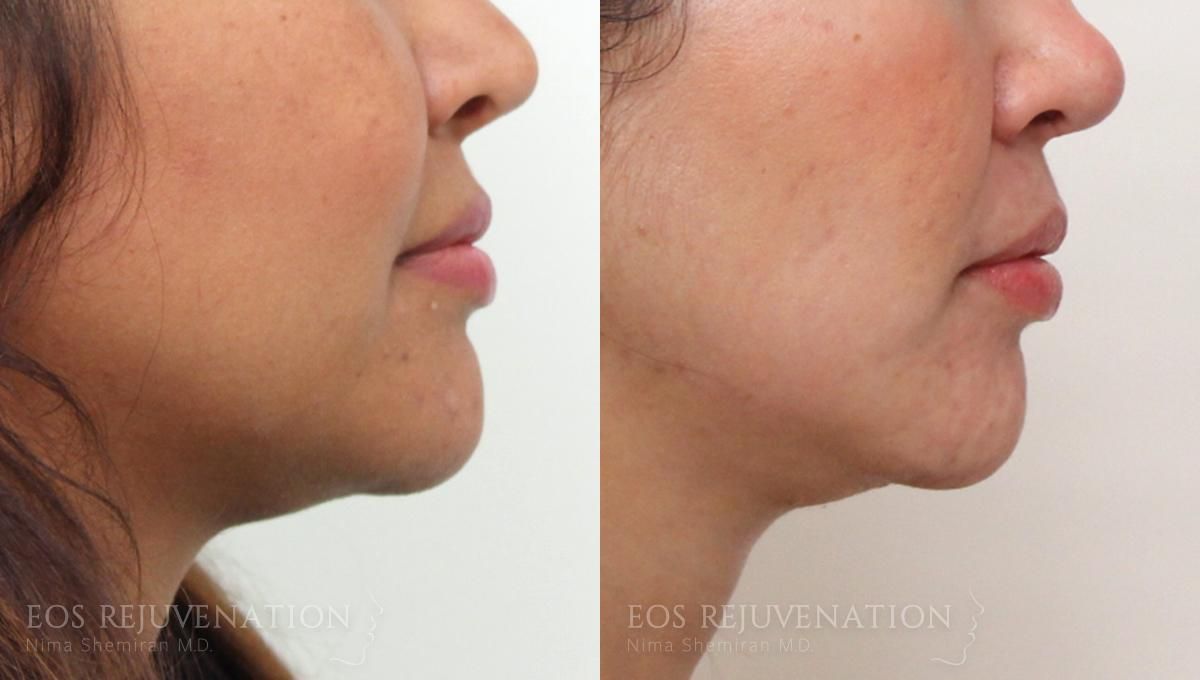 Neck Jawline Liposuction Before & After