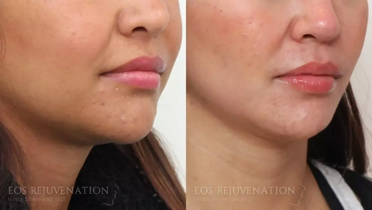 Neck Jawline Liposuction Before & After