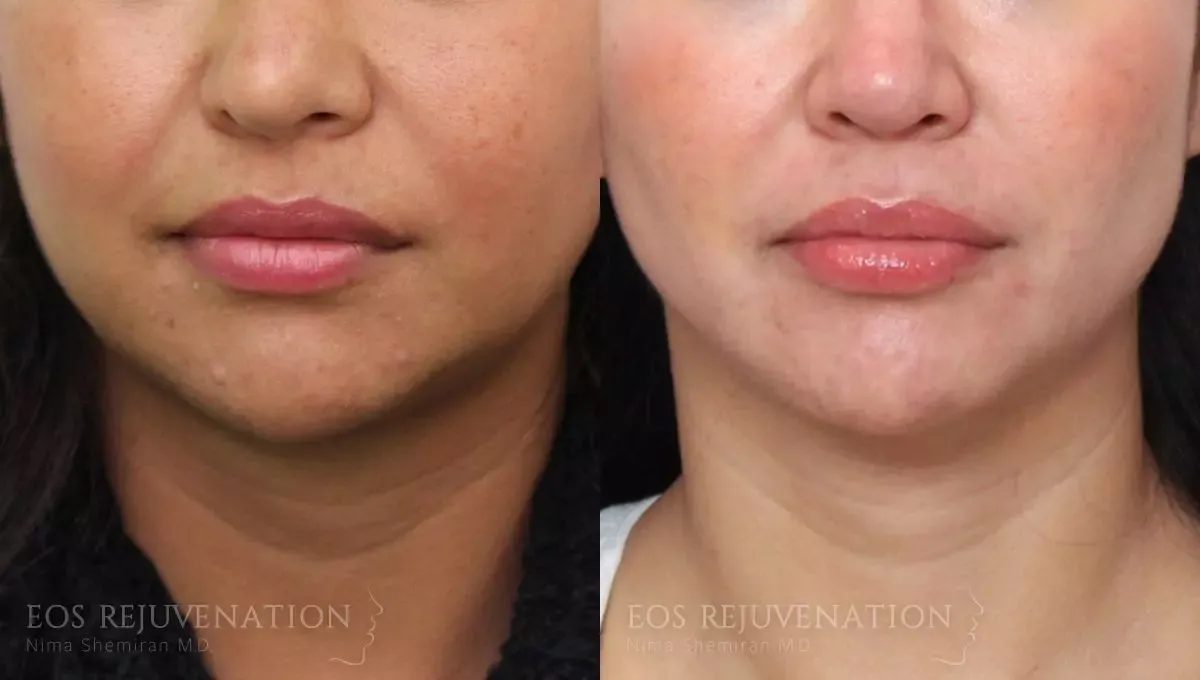 Neck Jawline Liposuction Before & After