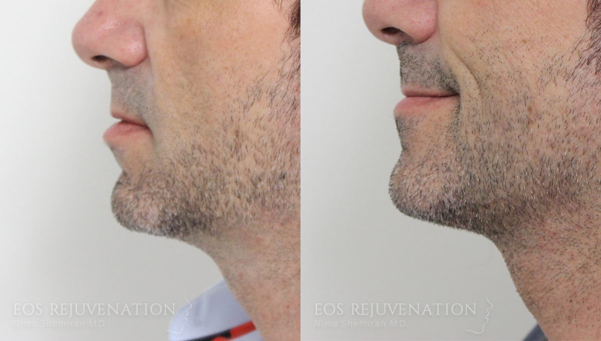 Neck Jawline Liposuction Before & After