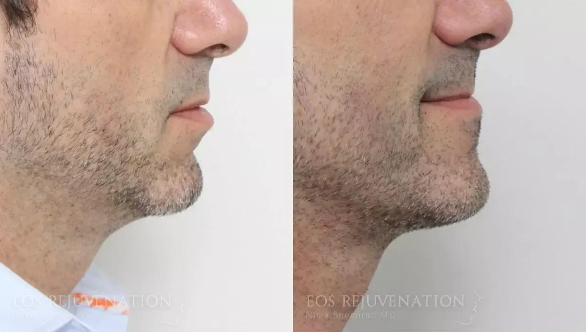 Neck Jawline Liposuction Before & After