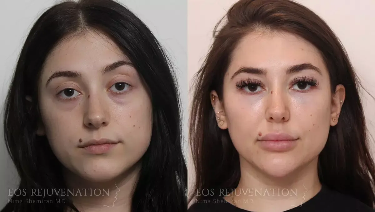 Neck Jawline Liposuction Before & After