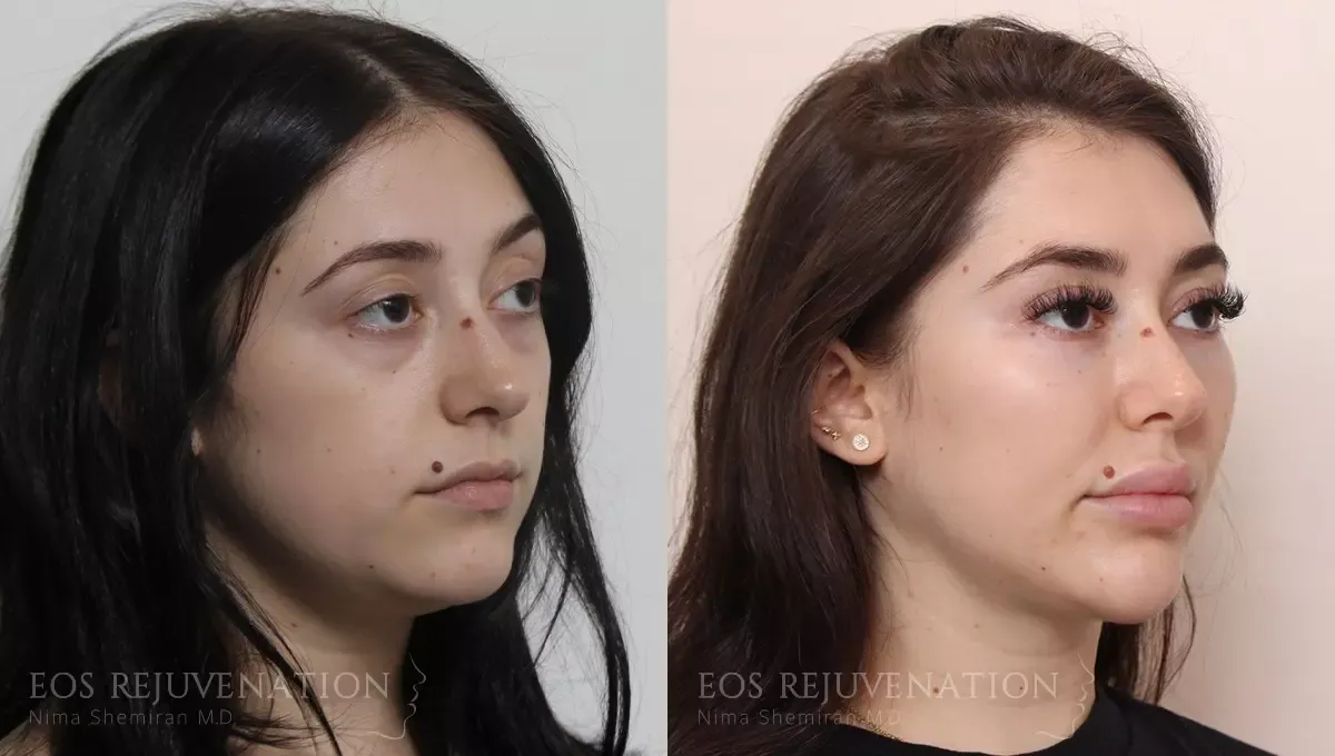 Neck Jawline Liposuction Before & After