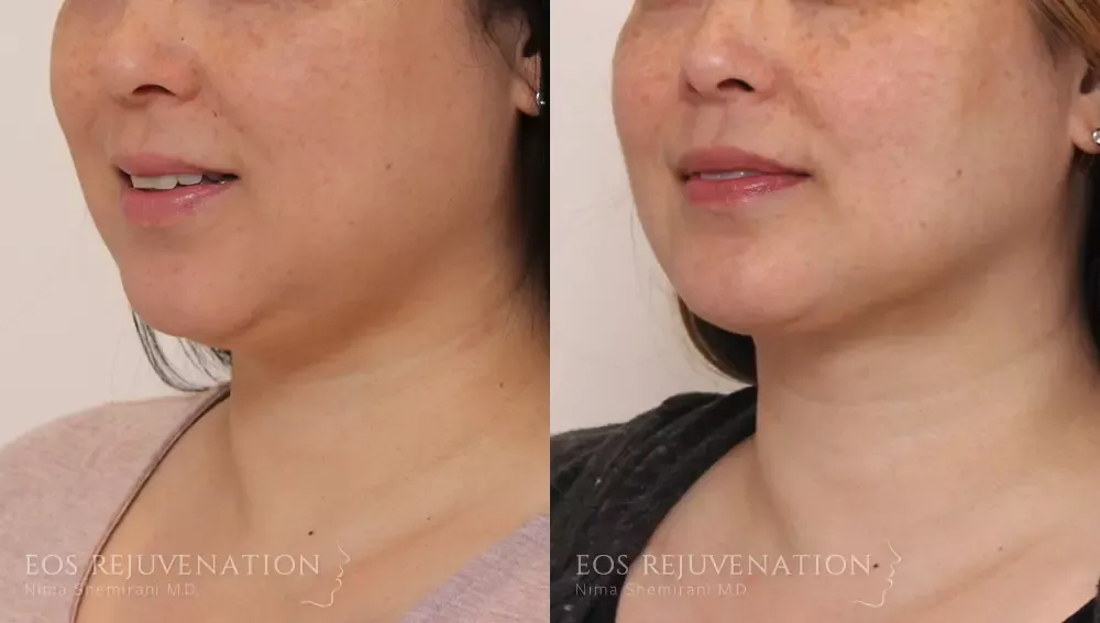 Neck Jawline Liposuction Before & After