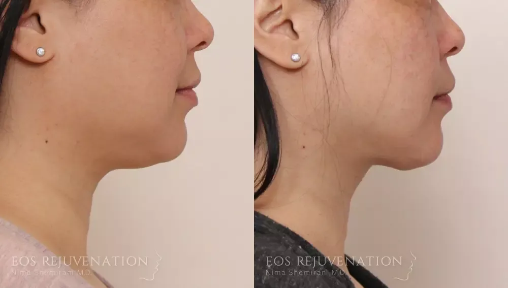 Neck Jawline Liposuction Before & After