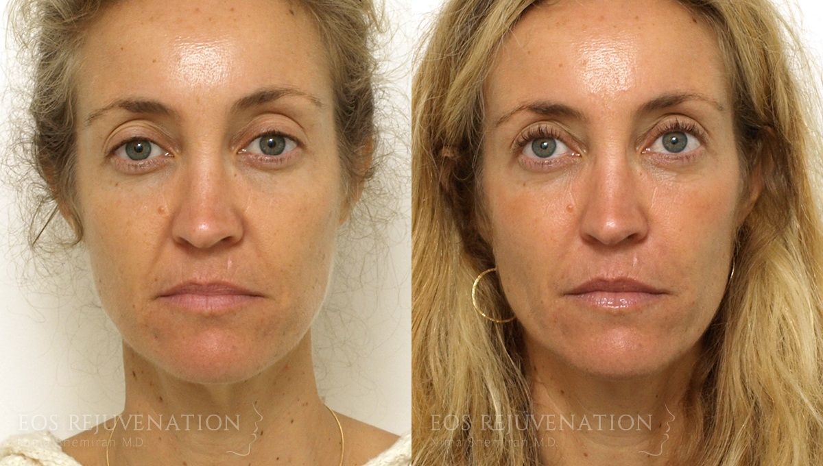 Fillers Before & After