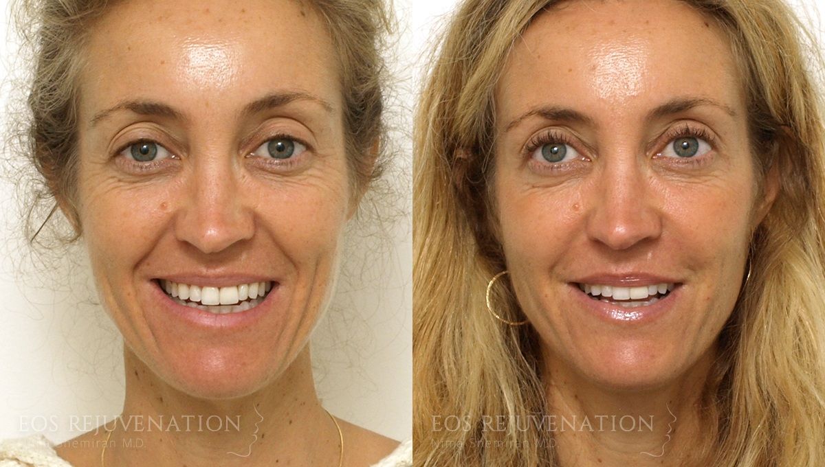 Fillers Before & After