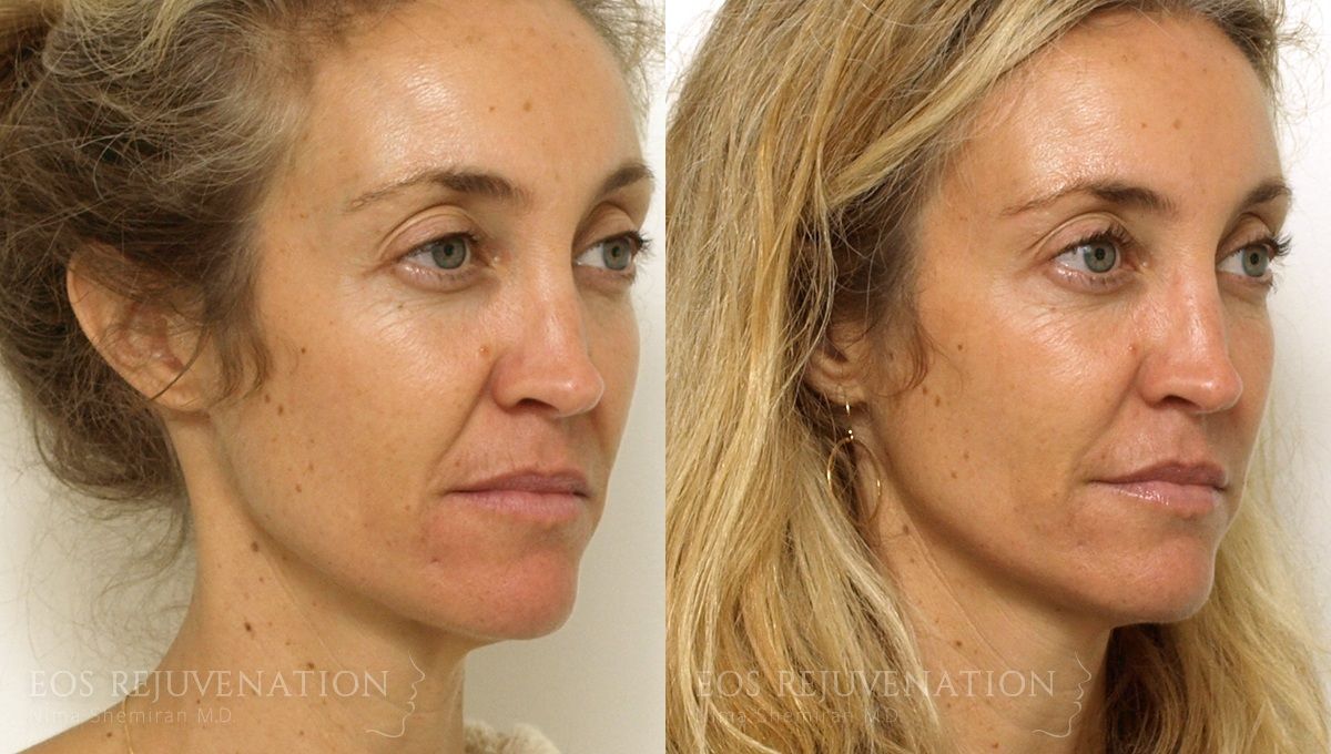 Fillers Before & After