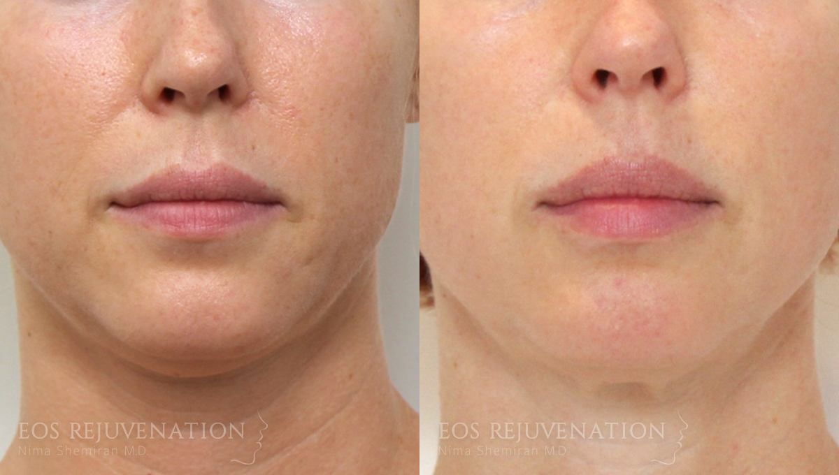 Fillers Before & After