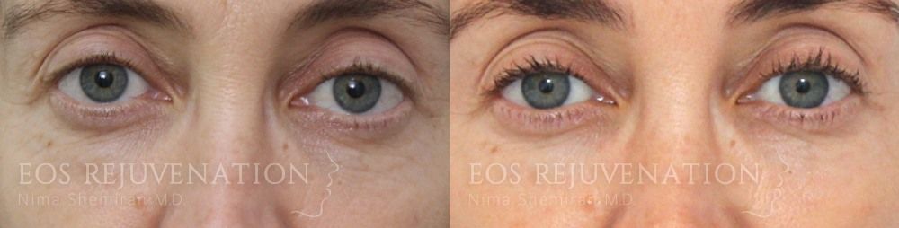 Fillers Before & After