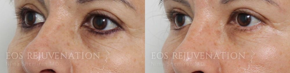 Fillers Before & After