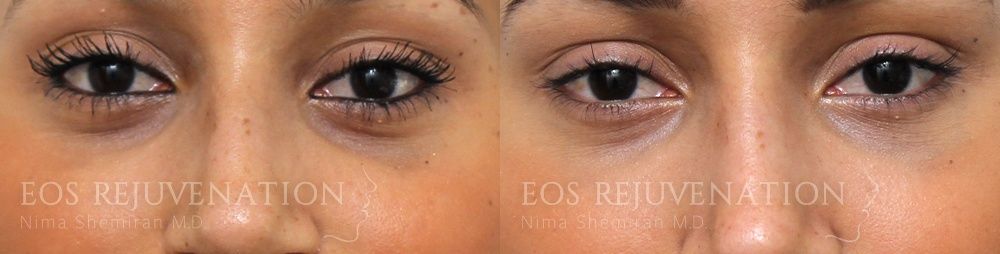 Fillers Before & After