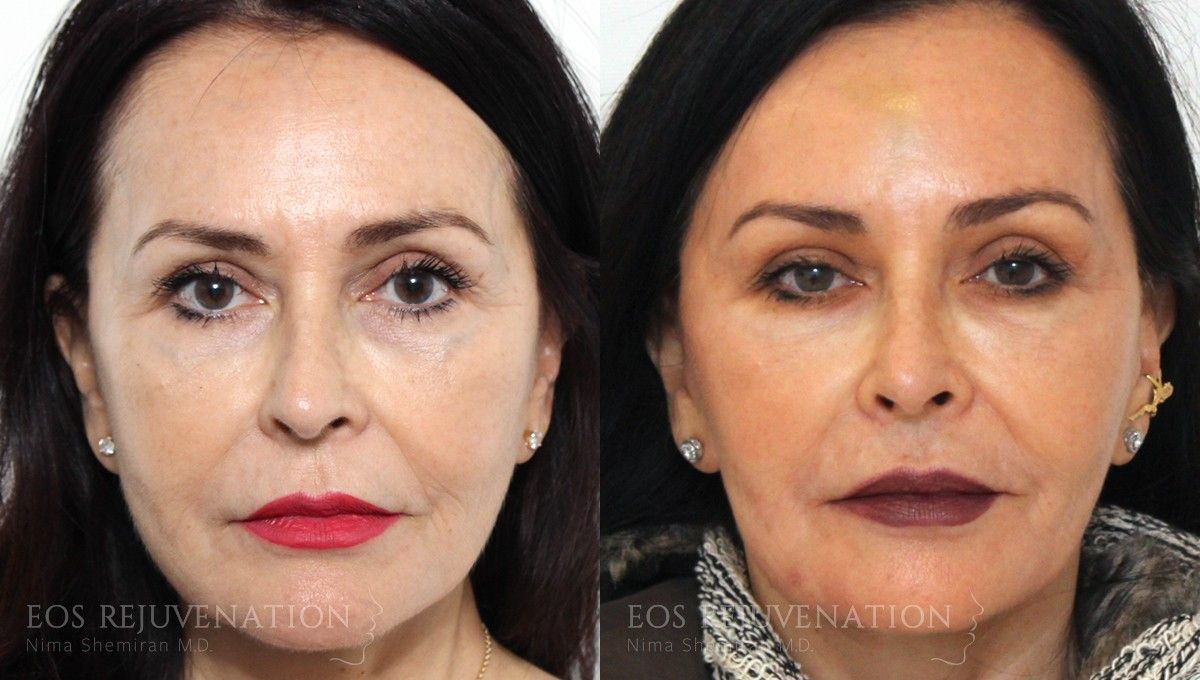Fillers Before & After
