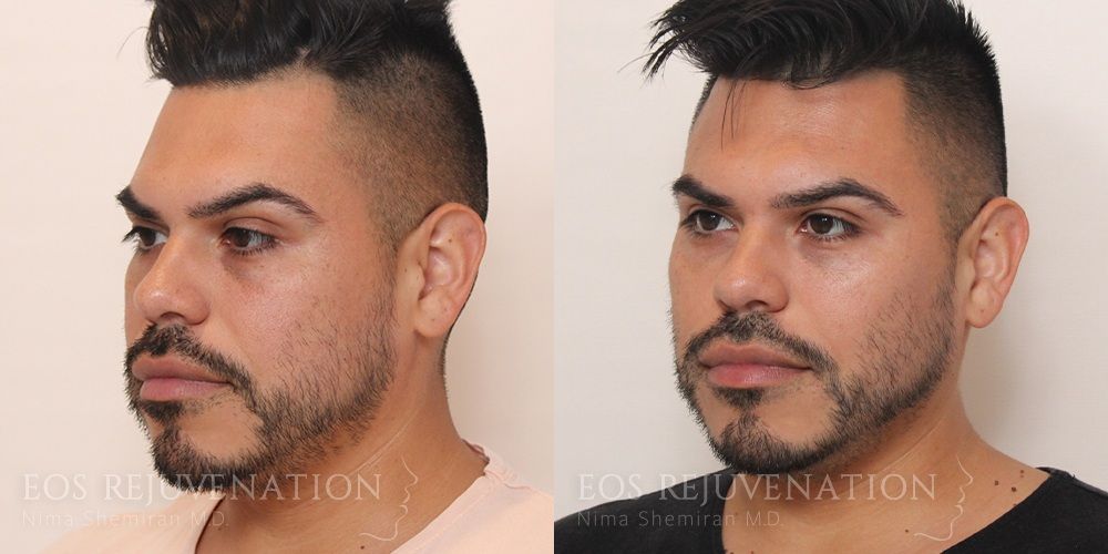 Fillers Before & After