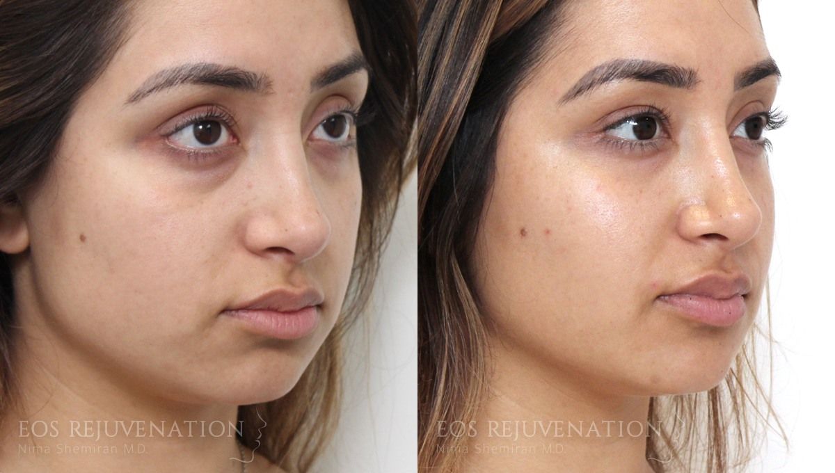 Fillers Before & After