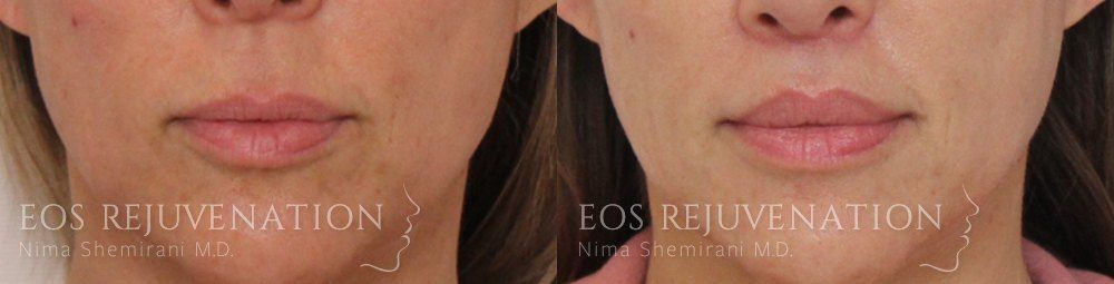 Lip Lift Before & After