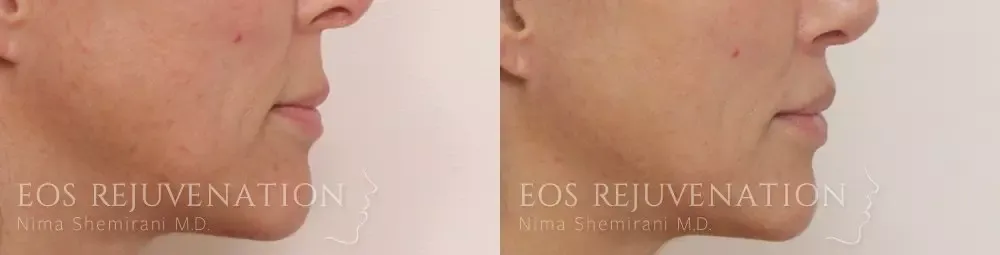 Lip Lift Before & After