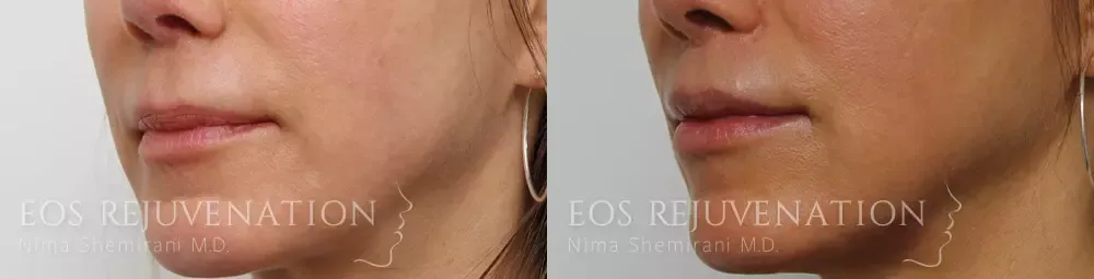 Lip Lift Before & After