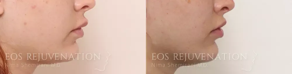 Lip Lift Before & After