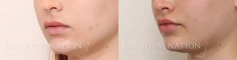 Lip Lift Before & After