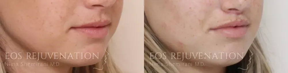 Lip Lift Before & After