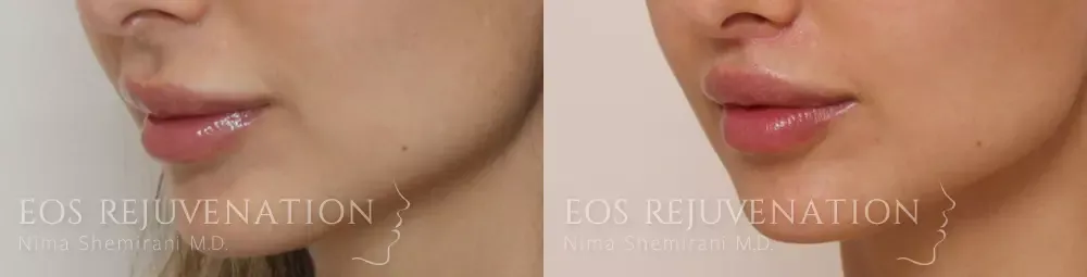 Lip Lift Before & After