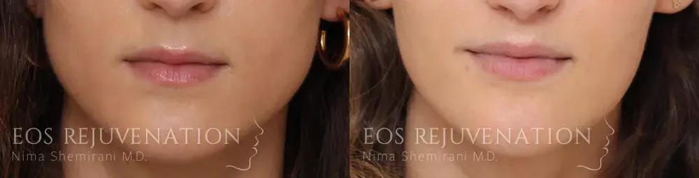 Lip Lift Before & After