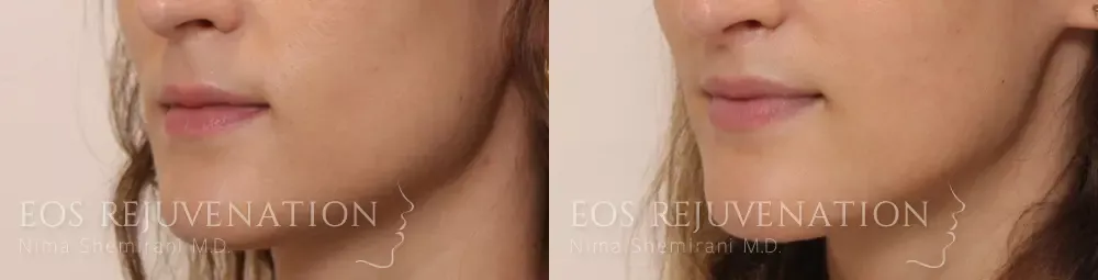 Lip Lift Before & After