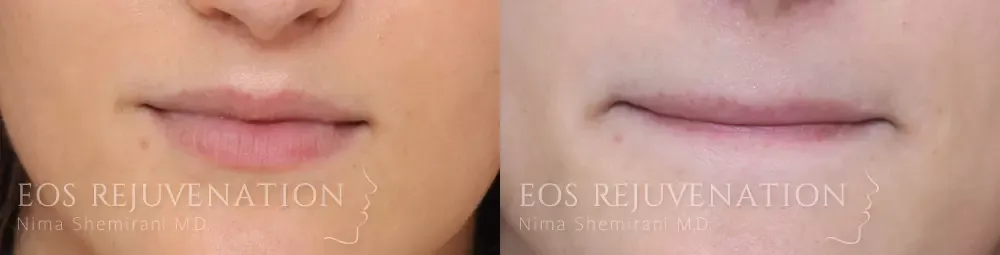 Lip Lift Before & After