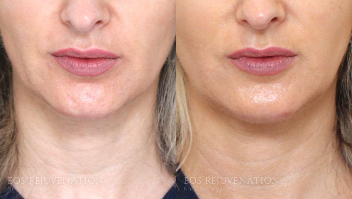 Microneedling Before & After