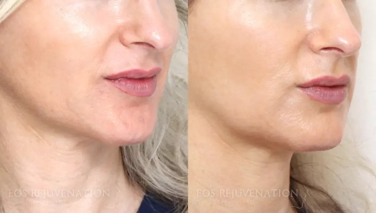 Microneedling Before & After